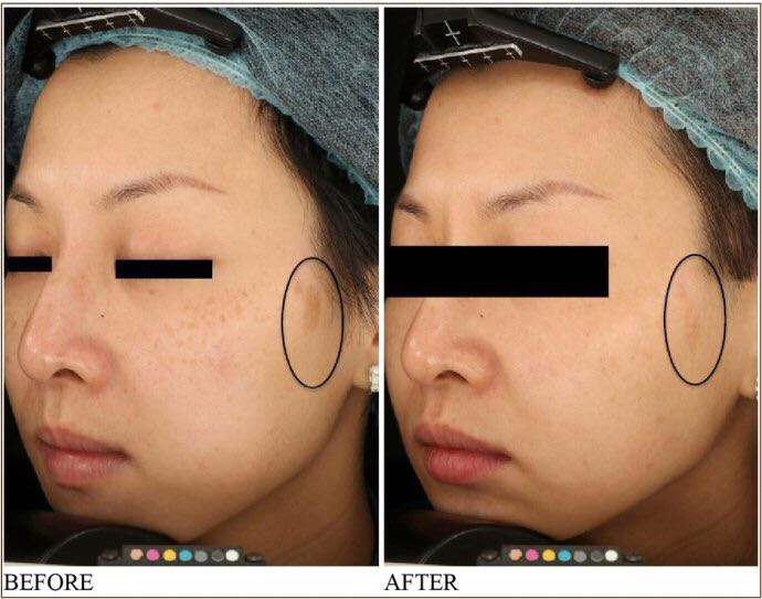 chloasma removal by pico laser